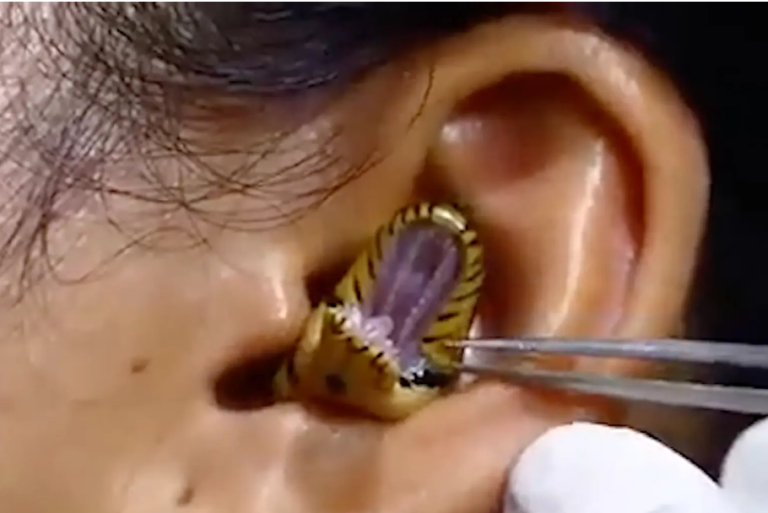 Prøver angivelig å fjerne slange fra kvinnes øre: Men er det ekte?